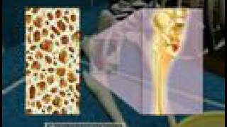 Osteoporosis3D Medical Animation [upl. by Fariss]