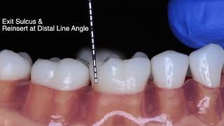 Periodontal Probe Basic Technique [upl. by Eiramalegna304]