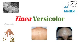 “Fungal Skin Infection of Many Colors” Tinea Versicolor  Pathogenesis Symptoms and Treatment [upl. by Luemas263]