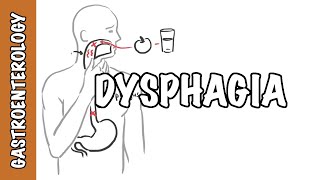 What Can I Do About Swallowing Difficulties Dysphagia  GutDr QampA [upl. by Yee]