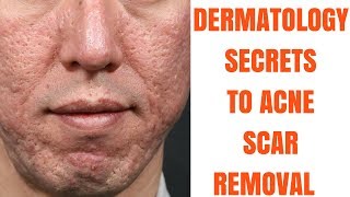 Acne scar treatments ULTIMATE GUIDE [upl. by Rahman]