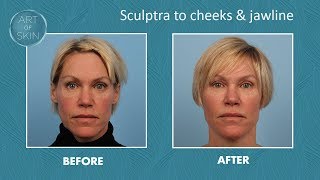 Sculptra filler for cheeks and jawline [upl. by Frederico883]