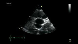 AORTIC BICUSPID VALVE ECHOCARDIOGRAM [upl. by Ellehs]