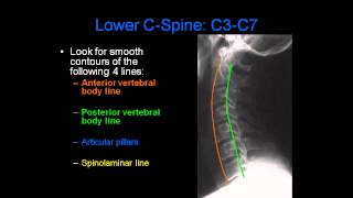 Constrictive pericarditis Etiology and presentation [upl. by Oirtemed]