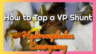 Tapping a VP Shunt for a Hydrocephalus Emergency [upl. by Zimmermann237]