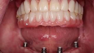 Introduction to the Smart Way to Convert a Denture to Fixed Implant Prosthesis [upl. by Sclater804]