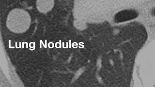 Lung Nodules basics for patients [upl. by Tuesday286]