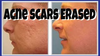 HOW TO COVER ACNE SCARS FLAWLESSLY  Tutorial  CHRIS GIBSON [upl. by Ueihtam]