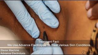 Skin Tag Electrolysis Procedure at Pulse Light Clinic London [upl. by Lednahc353]