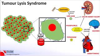 Tumour Lysis Syndrome [upl. by Reis]