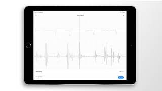 Atrial Fibrillation Combined Heart Sound PCG amp ECG Example  EkoCLINIC App [upl. by Mcgurn]