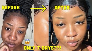 HOW I CLEARED MY SKIN in 1 WEEK and LIGHTENED my dark under eye circles [upl. by Modern475]