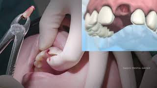 LIVE SURGERY DENTAL EXTRACTION AND BONE GRAFT [upl. by Aramoiz]