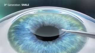 Relex SMILE versus LASIK versus PRK en LASEK [upl. by Ellery330]