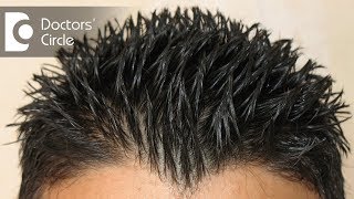 Alopecia Hair Makeover  How To Cover Bald Spots For Women  Alopecia Hair Transformation [upl. by Ahsiam]