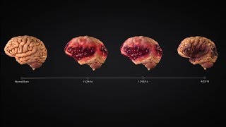 Traumatic Brain Injury Timeline Animation Charts Encephalomalacia [upl. by Marie-Ann967]