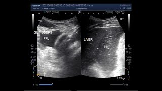 Approach to Pediatric Bowel Obstruction [upl. by Petronella420]