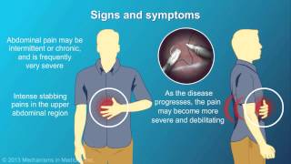 Chronic Pancreatitis [upl. by Santana876]