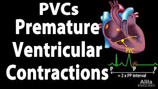 Premature Ventricular Contractions PVCs Animation [upl. by Franzoni]