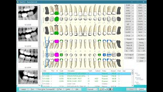 Eaglesoft  Patient Chart [upl. by Notnek]