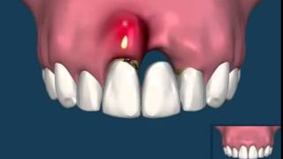 The Difference Between A Dental Bridge and Dental Implants [upl. by Arag485]