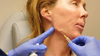 Jawline Correction with Filler with Dr Janowski [upl. by Nochur]