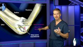 Cubital Tunnel Surgery [upl. by Christmann]