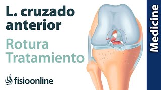 Rotura de ligamento cruzado anterior  Diagnóstico tratamiento de fisioterapia médico y quirúrgico [upl. by Nwahsat]