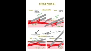 Venipuncture  How to Position a Needle [upl. by Michey]