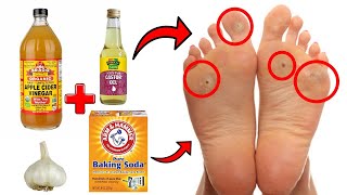 14 Proven Home Remedies For Corns amp Callus Removal THAT WORK [upl. by Rorrys]