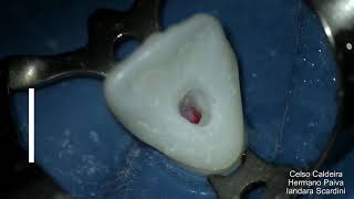 Endodontia Cirurgia de acesso Incisivo Central Superior [upl. by Yelsnya]