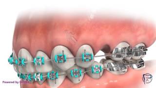 TAD for Molar Protraction [upl. by Notsej]