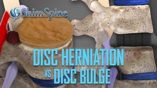 Disc Herniation vs Disc Bulge [upl. by Aip]