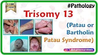 Trisomy 13 Patau or BartholinPatau syndrome  Causes  Diagnosis  Treatment [upl. by Berthoud922]