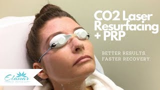 CO2 Laser Skin Resurfacing  PRP  Better Results and Faster Recovery [upl. by Narret]