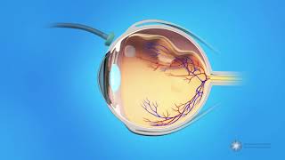 Retinal Detachment Symptoms and Treatment  How Retinal Detachment is Treated [upl. by Moht150]