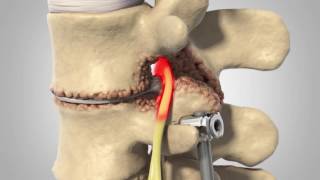 Adjacent Segment Disease  Patient Animation [upl. by Atnauq233]