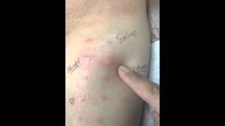 What is allergy testing [upl. by Ennasus]