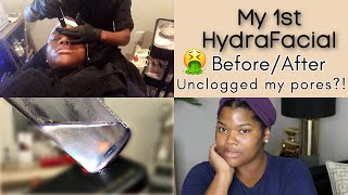 My First HydraFacial Treatment  Review Results Before amp After  for Black Skin Acne Anti Aging [upl. by Viridissa164]