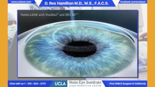 How LASIK Eye Surgery Is Performed [upl. by Jegar]