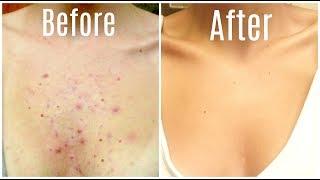 How I Got Rid Of My Body Acne FOREVER [upl. by Nyleahcim]