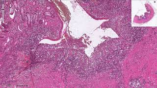 Crohns Disease  Histopathology [upl. by Hareemas]