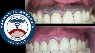 Tips for a Successful Gingival Depigmentation [upl. by Statis751]