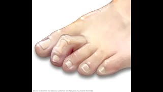 How to treat hammer toes without surgery  Benjamin Marble DPM [upl. by Sutsuj]